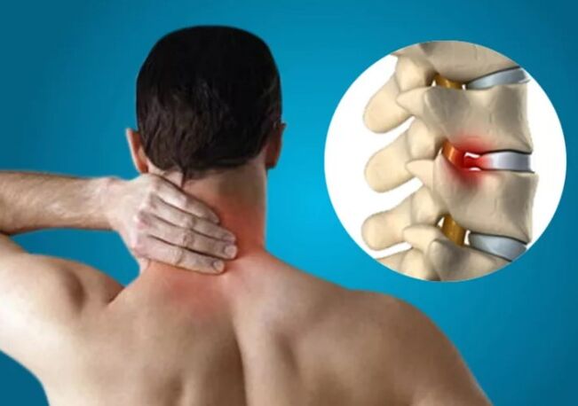 Osteochondroza szyjka macicy