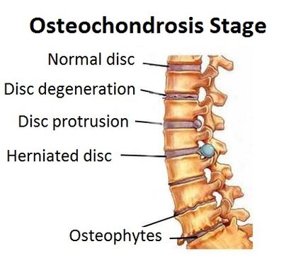 Etapy osteochondrozy