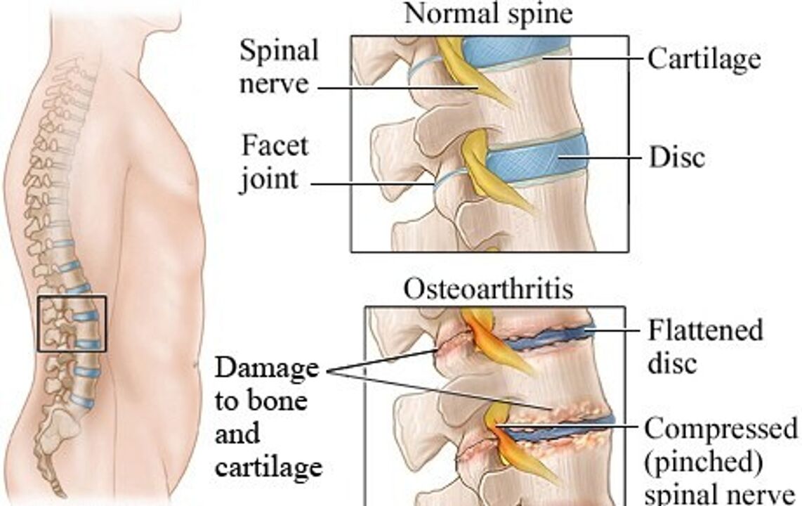 Różnica między zdrowym dyskem a dysku z osteochondrozą